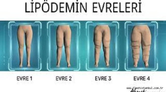 KİLO VEREMİYORSANIZ SUÇLU İRADENİZ DEĞİL LİPÖDEM OLABİLİR!,,