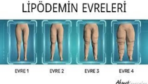 KİLO VEREMİYORSANIZ SUÇLU İRADENİZ DEĞİL LİPÖDEM OLABİLİR!,,