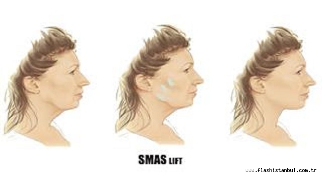 NANOTEKNOLOJİ VE DERİN SMAS LİFT YÜZ GERMEYİ ŞEKİLLENDİRİYOR