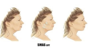 NANOTEKNOLOJİ VE DERİN SMAS LİFT YÜZ GERMEYİ ŞEKİLLENDİRİYOR