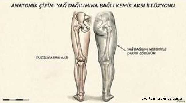 ÇARPIK BACAKLARI KEMİK KIRMADAN TEDAVİ YÖNTEMİ