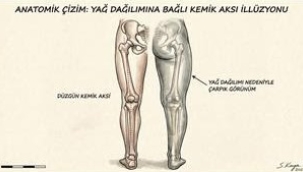 ÇARPIK BACAKLARI KEMİK KIRMADAN TEDAVİ YÖNTEMİ